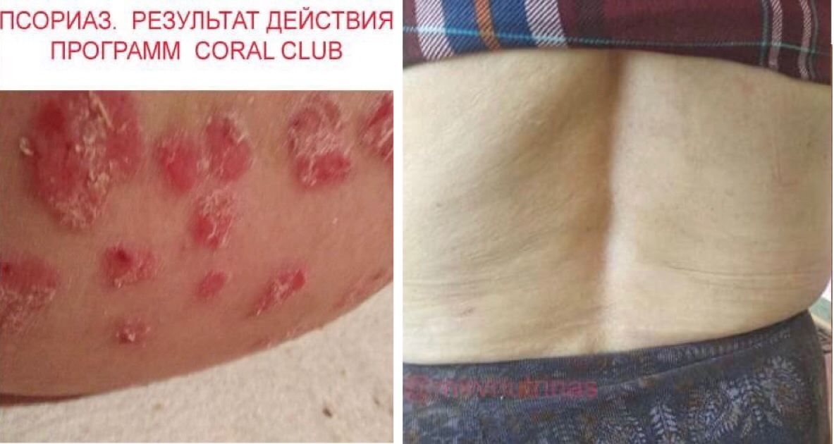 ПСОРИАЗ - РЕЗУЛЬТАТЫ ПРИМЕНЕНИЯ ПРОГРАММ CORAL CLUB ЗА 9 МЕСЯЦЕВ