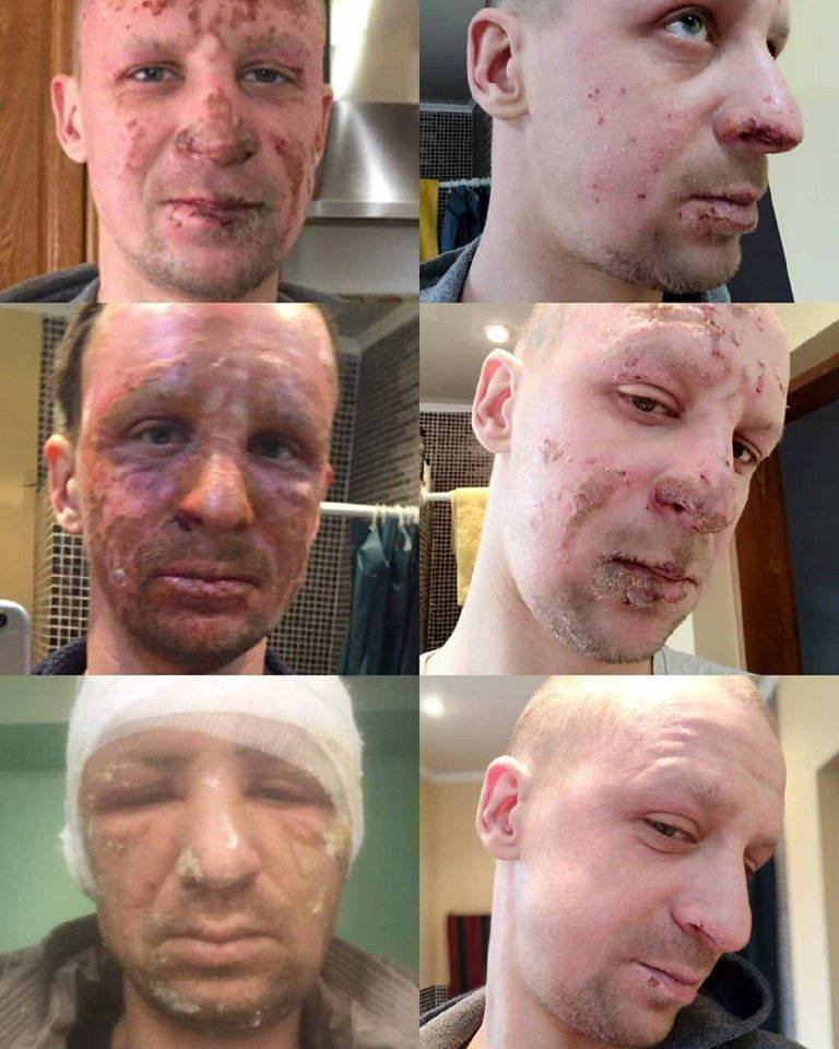 Востановленние кожи после ожога